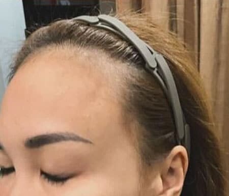 Receding hairline before microneedling with IYASHI exosomes