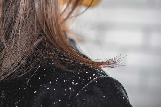 7 Everyday Triggers Making Your Scalp Dermatitis Worse