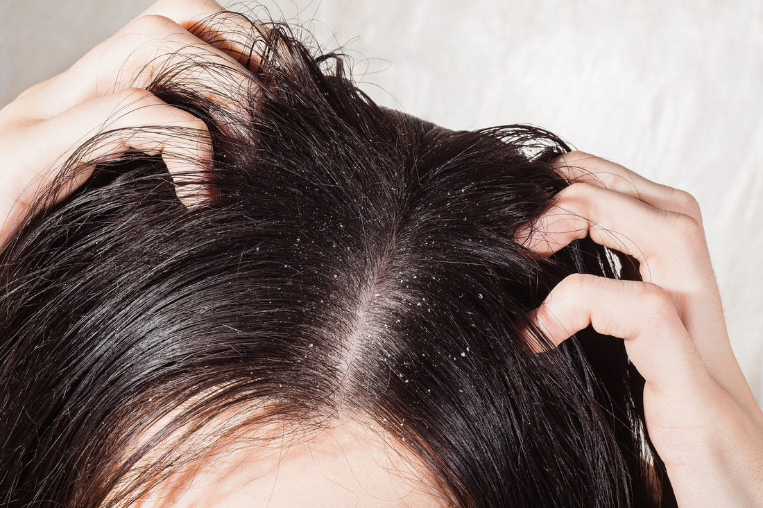 5 Common Questions About Dandruff: Our Experts Weigh In