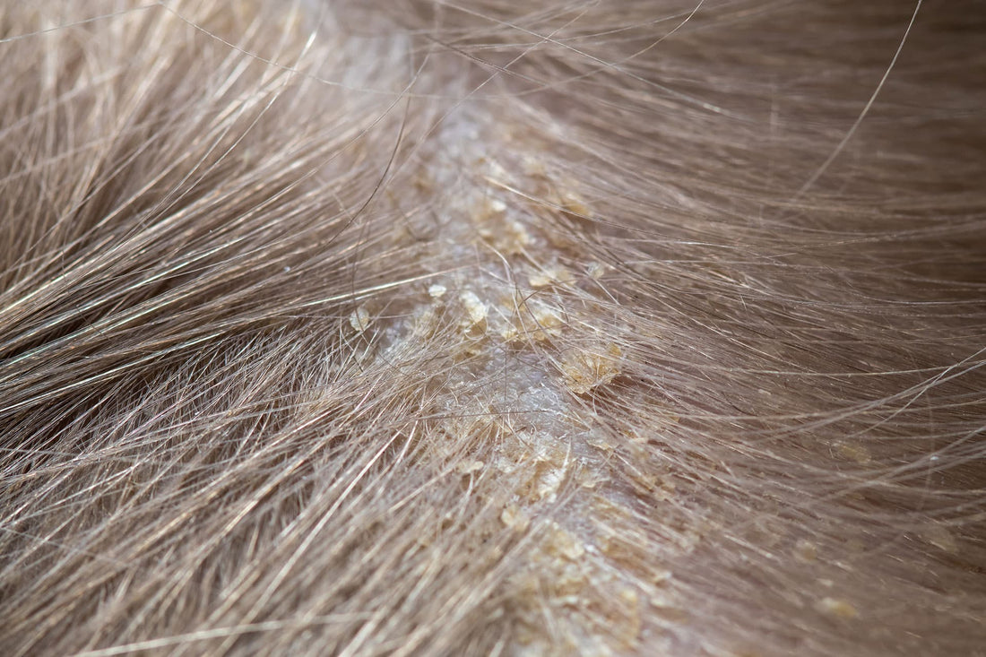 Is It Dandruff or Not? Understanding Scalp Dermatitis