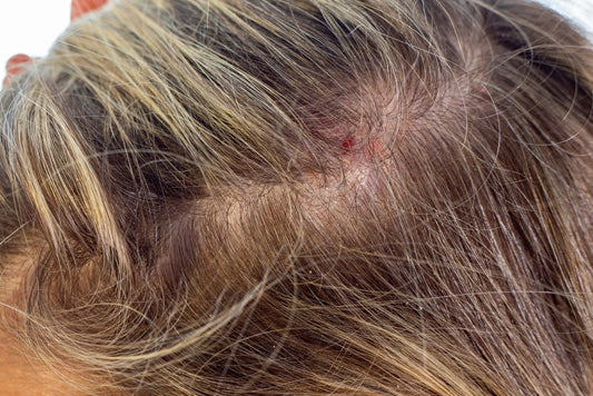 How to manage scalp eczema during a flare-up