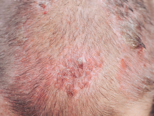 Scalp folliculitis: Symptoms, types and treatment