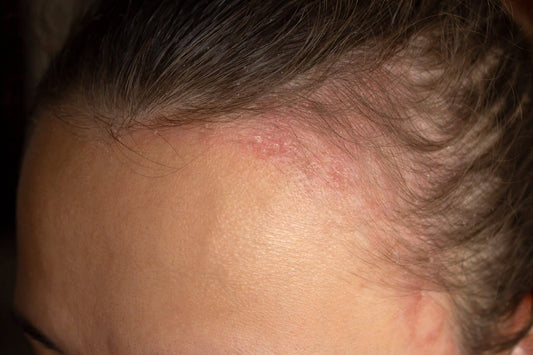 How to choose the right shampoo for scalp psoriasis relief
