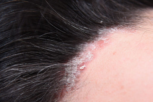 Scalp Psoriasis vs Dandruff: What's the difference?