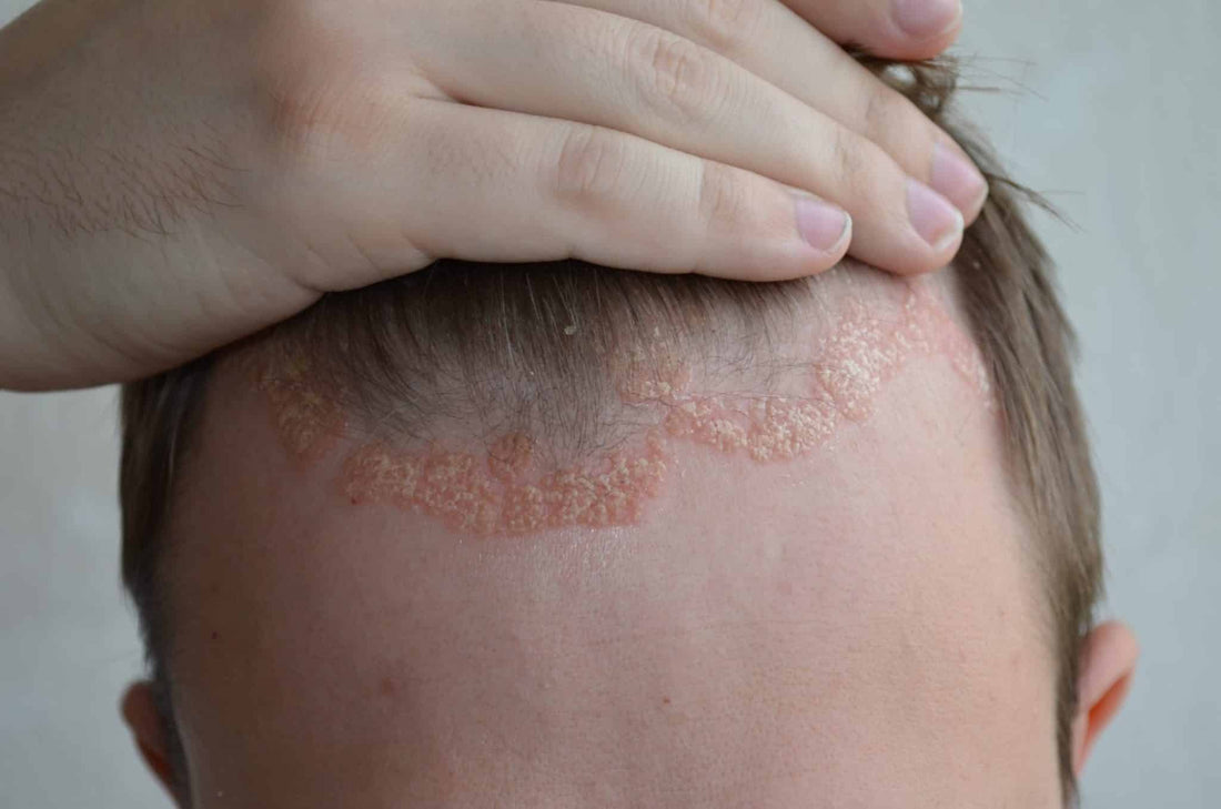 3 Common Scalp Disorders | TrichoLab