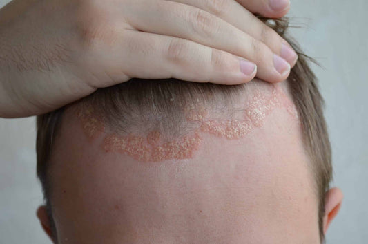 3 Common Scalp Disorders | TrichoLab