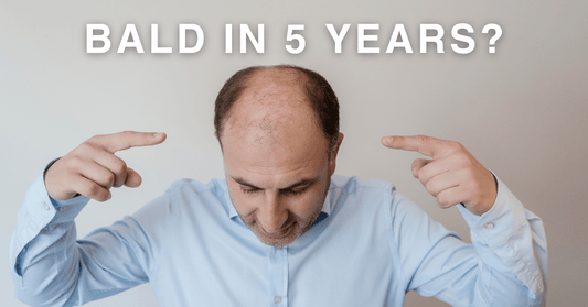 How to Predict if You'll Be Bald