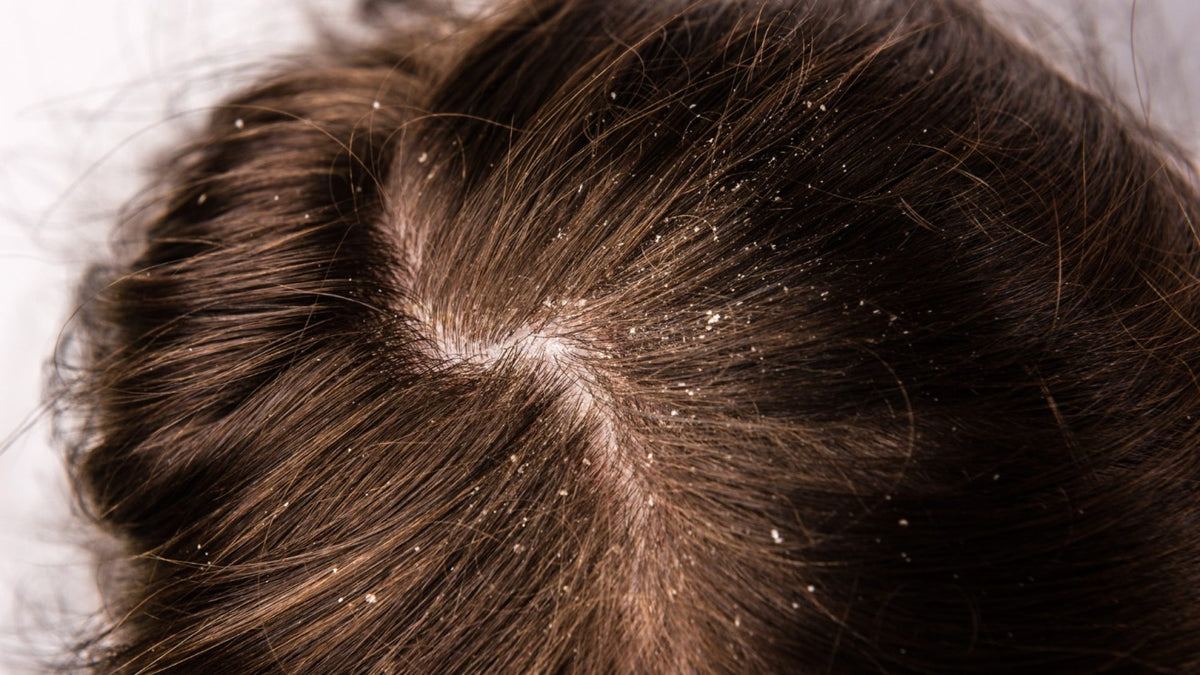 Demodex Scalp Treatment