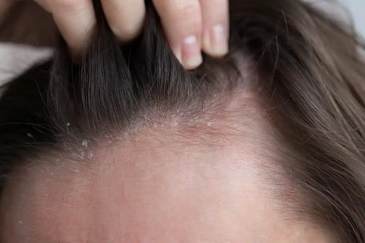 Close-up of dry dandruff flakes on the scalp