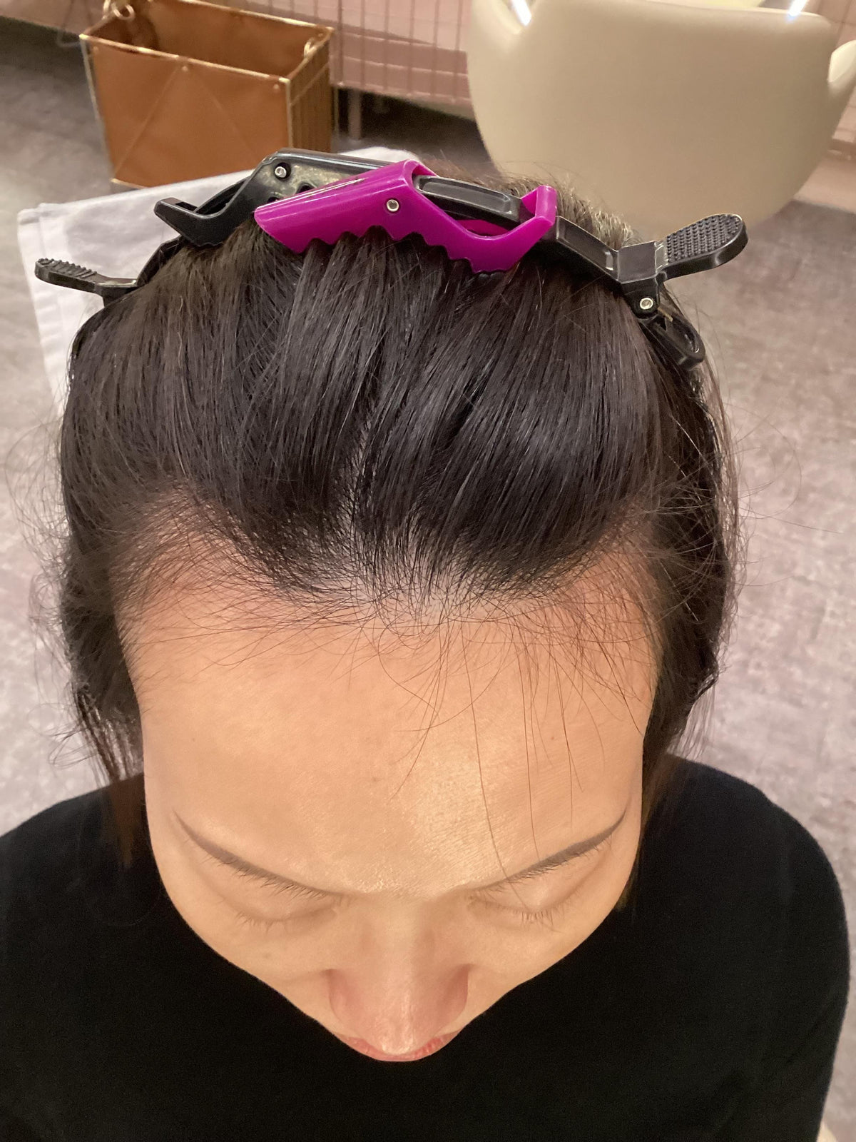After — Hair Loss