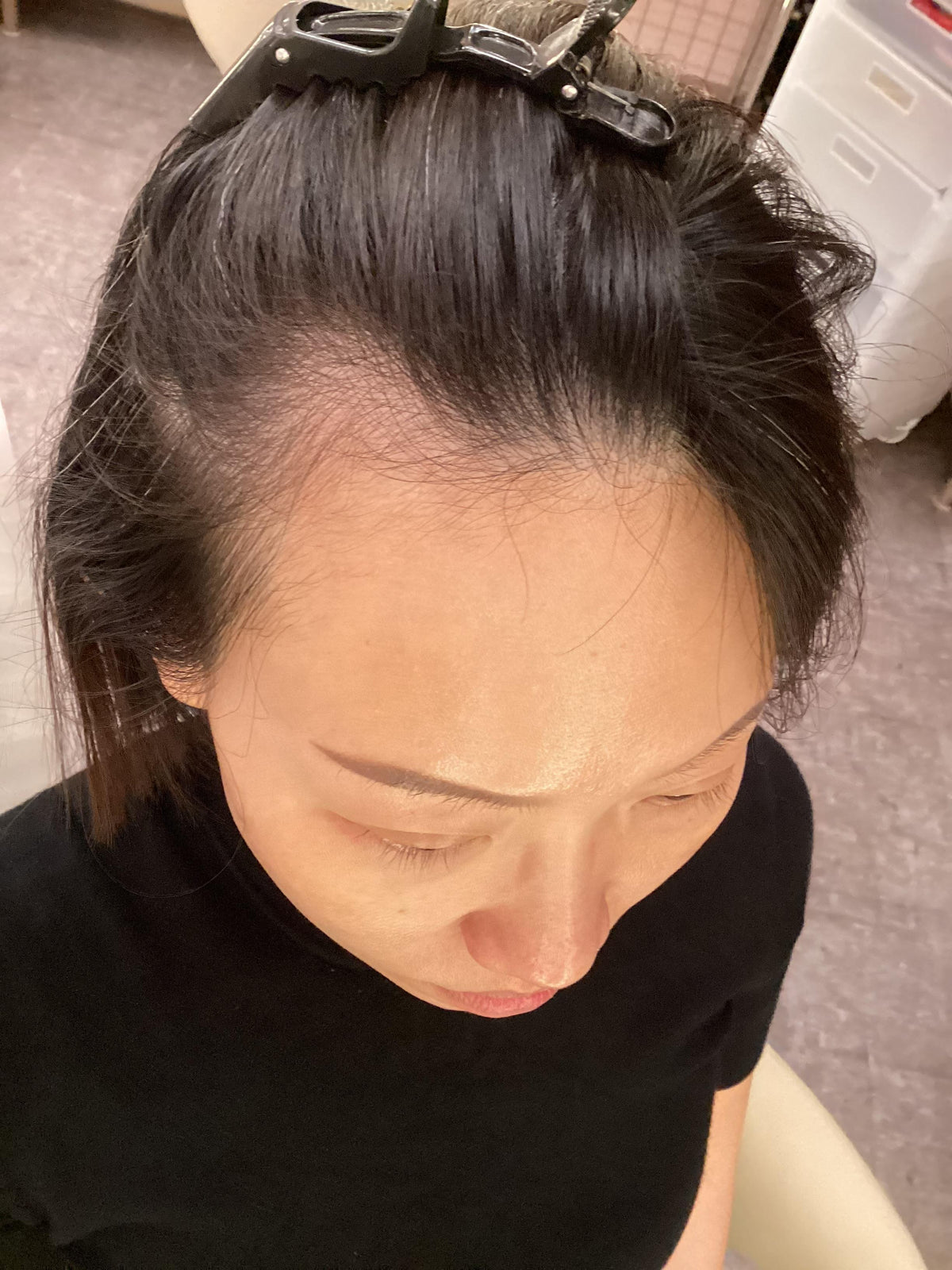 Before — Hair Loss