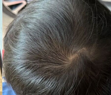 Crown with visibly improved density after microneedling with IYASHI exosomes
